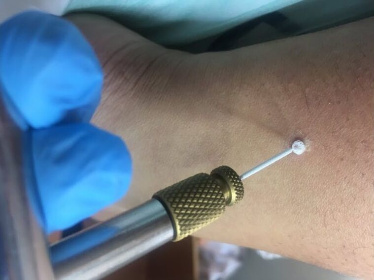 Τρόποι αφαίρεσης κονδυλωμάτων